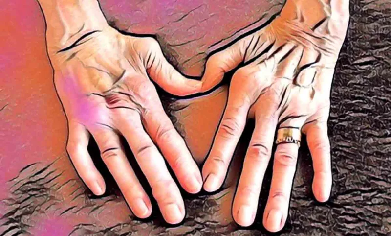 romatoid artrit nedir