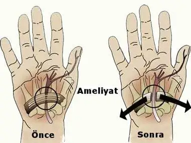 Sinir-sıkışması.webp