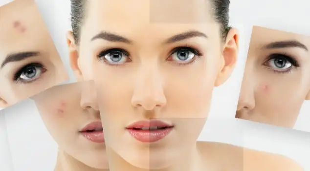 sivilce-lekeleri-icin-maske-14725476714896_634x350.webp