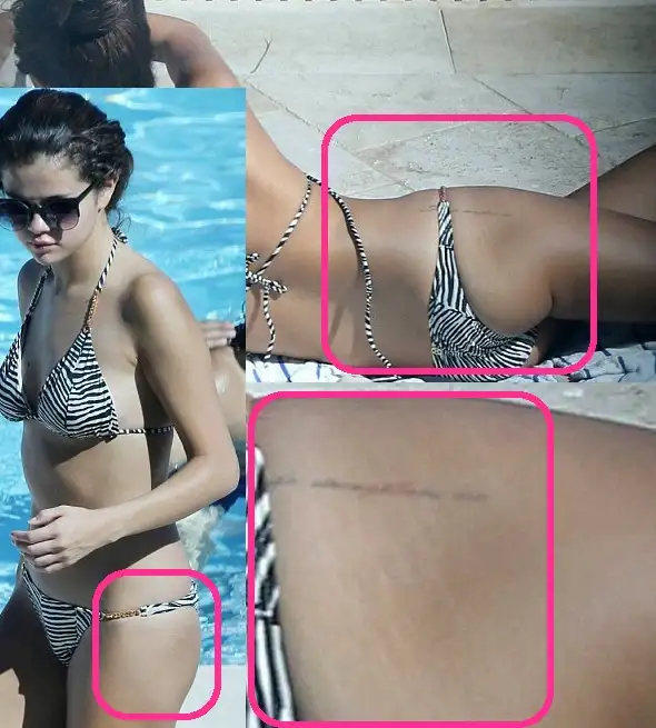 stretch-marks.webp