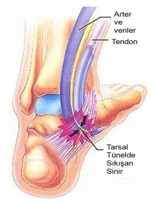 tarsal2.webp