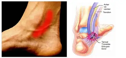 tarsal_tunel.webp