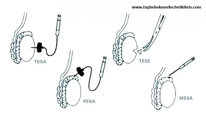 tesa-tese.webp