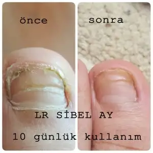tırnak mantarı.webp