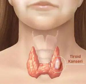 tiroid-kanserlerinde-global-artis.webp