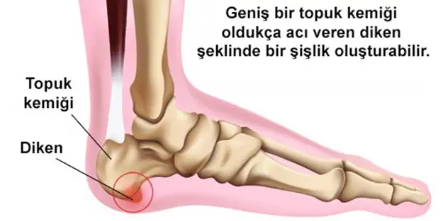 topuk-dikeni-nasil-onlenir-h1426946295.webp