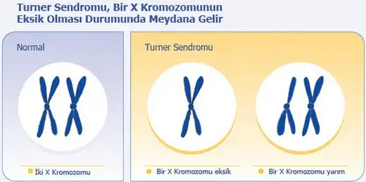 turner-sendromu-nedir.webp