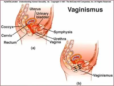 vaginismus-nedir-1.webp