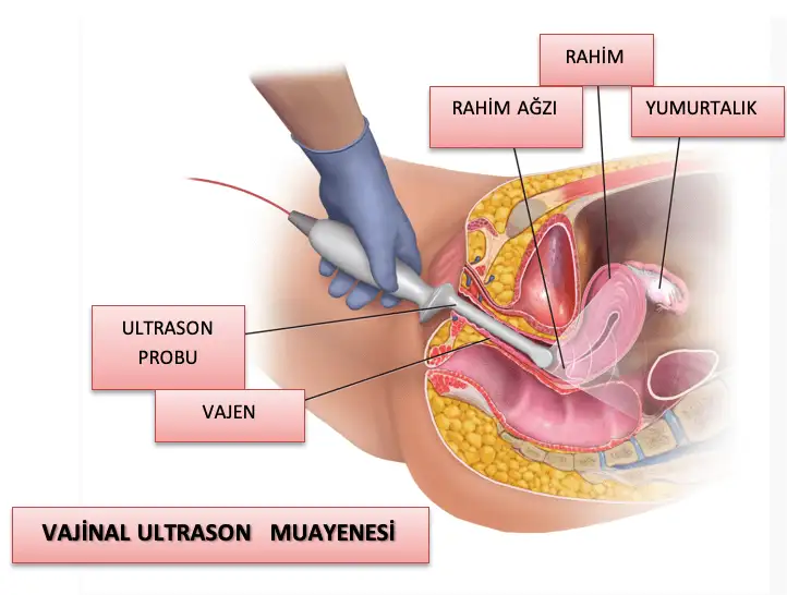 vajinalultrasonmuayenesi.webp