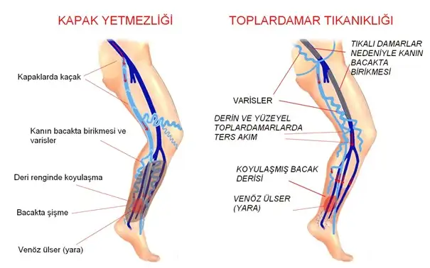 venoz-toplardamar-yetmezlik.webp
