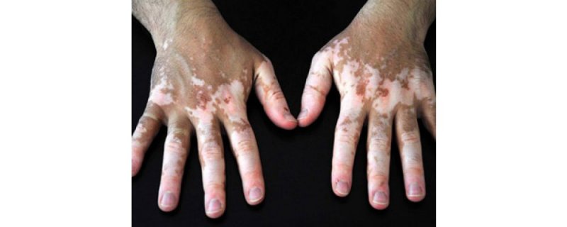 vitiligo-antalya.jpg