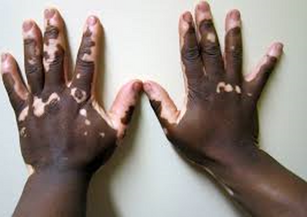 vitiligo.png