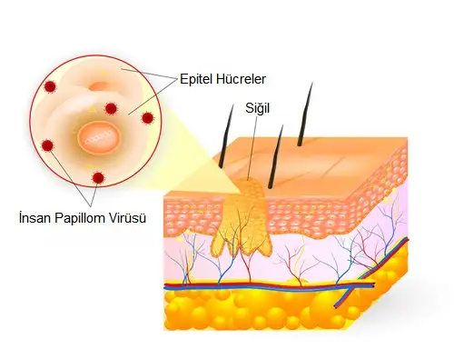 wart-21.webp