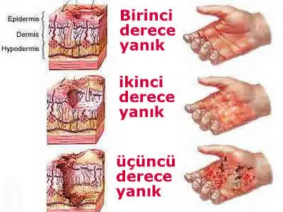 yaniklar.webp