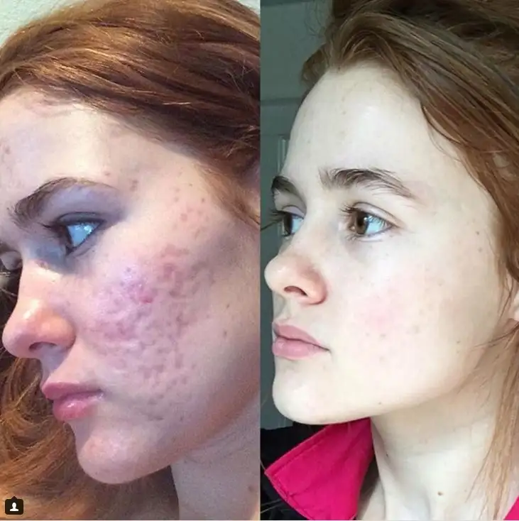 yuzdeki_sivilce_izleri_derma_rolu.jpg