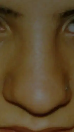 $Ameliyat önce.webp
