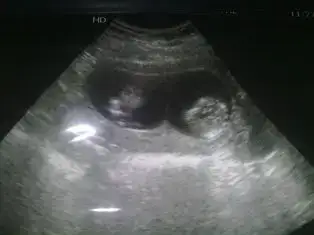 $23082011009ultrason.webp