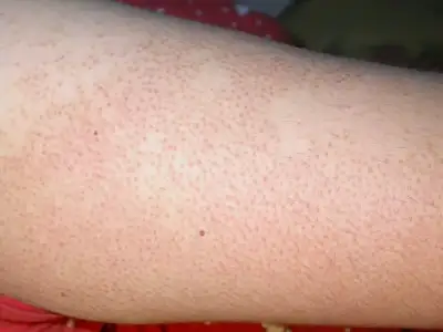 keratosis_pilaris_1_0303241.webp