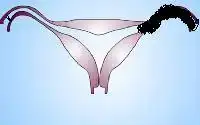 arcuat-uterus.webp