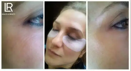 botox.webp