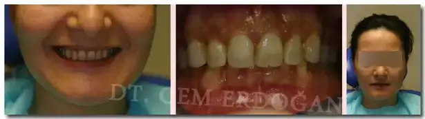 $Hastan&#305;n-&#304;lk-Te&#351;hisi-copy1.webp