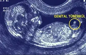 erkek+fetus+işaretsiz.webp
