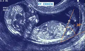 erkek+fetus+işaretli.webp