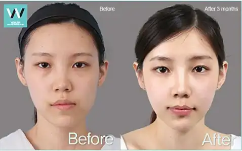 b99c4-facialasymmetrycorrection_01.webp