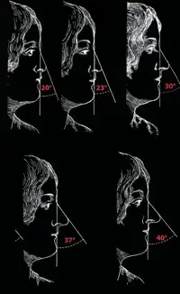 nasofacial-açı-değişimi-ve-burun-ucu-projeksiyonu.webp