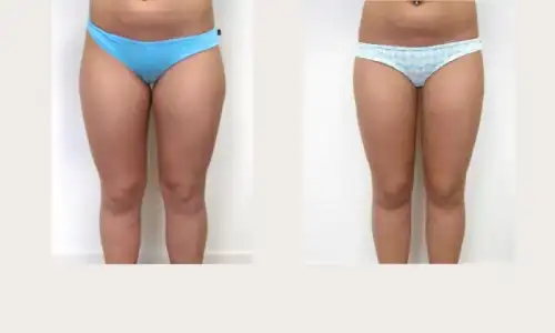 before-after-thigh03-lipo.webp