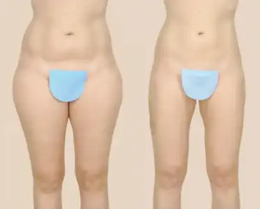 Thigh-liposuction-pre-and-post.webp