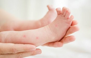 Bebeklerde Sivrisinek Isırığı Nasıl Geçer?