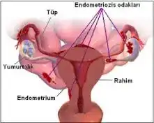 endometriozis.webp