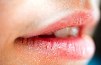 Kışın dudak çatlamalarına ne iyi gelir?