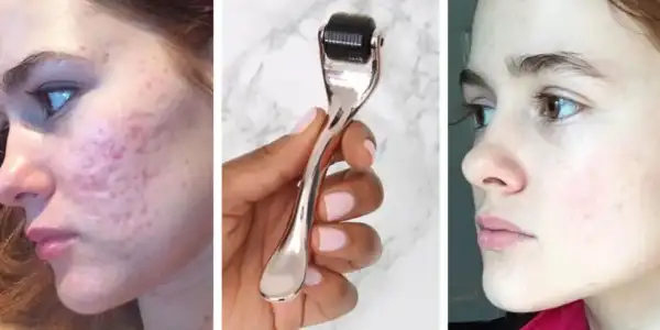 Yüzdeki İzleri Yok Eden Derma Rulo Nasıl Kullanılmalı?