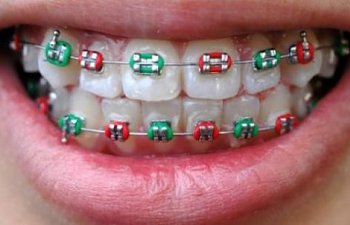 Diş Teli Kullananların Bilmesi Gerekenler