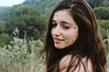 dogum_lekesi_tedavisi.jpg dogum_lekesi_tedavisi.jpg