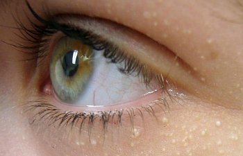 Göz Altındaki Yağ Bezesi (Milia) Nedir? Nasıl Tedavi Edilir?