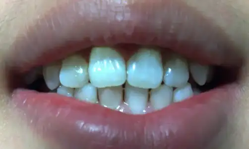 $teeth%20done[1].webp