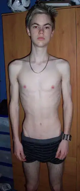 $dan-anorexic-280_70524a.webp