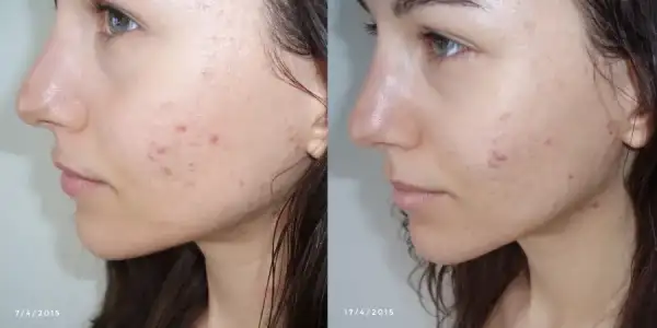 Cilde En Hızlı Bakım! Kuşburnu Yağı