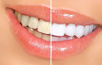 Diş Plağını Çıkarmanın Doğal Yolları Diş Taşı Temizleme