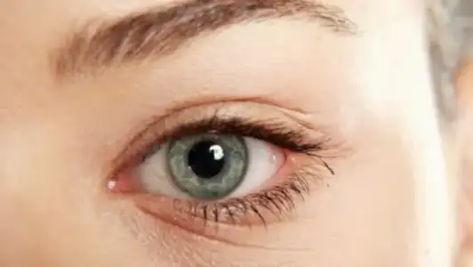 goz_alti_kirisikliklari_nasil_gecer_ne_iyi_Gelir.webp