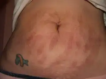 $stretchmark1sm[1].webp
