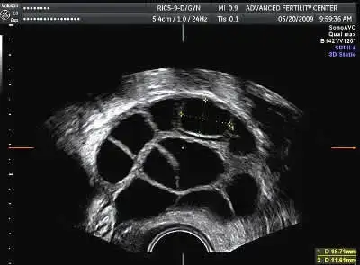 $ovarian_stimulation.webp