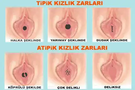 $kizlik_zari_tipleri.webp