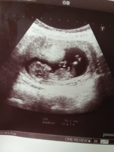 ultrason cinsiyet belirleme kiz erkek bebek page 2 kadinlar kulubu