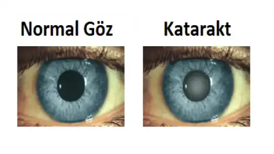 normal_Goz_ve_katarakt_Goz.png