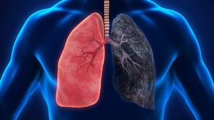 Akciğer Kanseri Teşhisi Nasıl Konulur? Belirtileri Nelerdir?