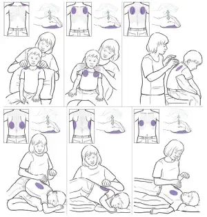 how-to-do-chest-percussions-to-help-your-child-drain-mucus-from-the-lungs-3.webp